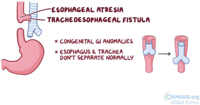 Eosophagal Astria