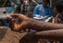 12 new cases of Mpox confirmed; total now 980 – Ghana Health Service