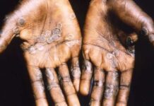 Mpox outbreak: Practicing preventive measures key – GHS advises general public