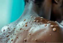 13 new Mpox cases confirmed; total reaches 993