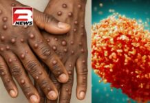 Ghana records first Mpox death as cases rise to 257