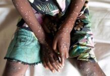 Mpox infections in Ghana now 657 after 36 new cases – GHS