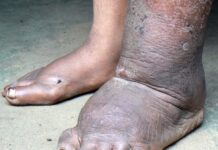 Journalists urged to highlights efforts at eliminating Neglected Tropical Diseases