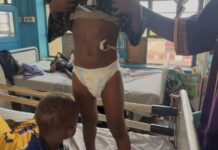 Haruna Iddrisu sponsors $27,000 surgery for 6-year-old boy at KATH