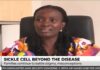 2 in every 100 babies born in Ghana have sickle cell disease – Health expert