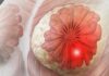 Breast cancer cases rise among younger women; experts call for early screening