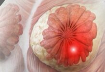 Breast cancer cases rise among younger women; experts call for early screening